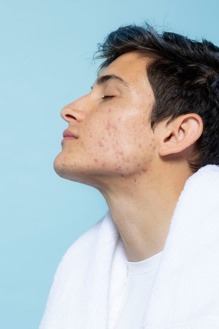 Acne scar removal and skin resurfacing treatment for men